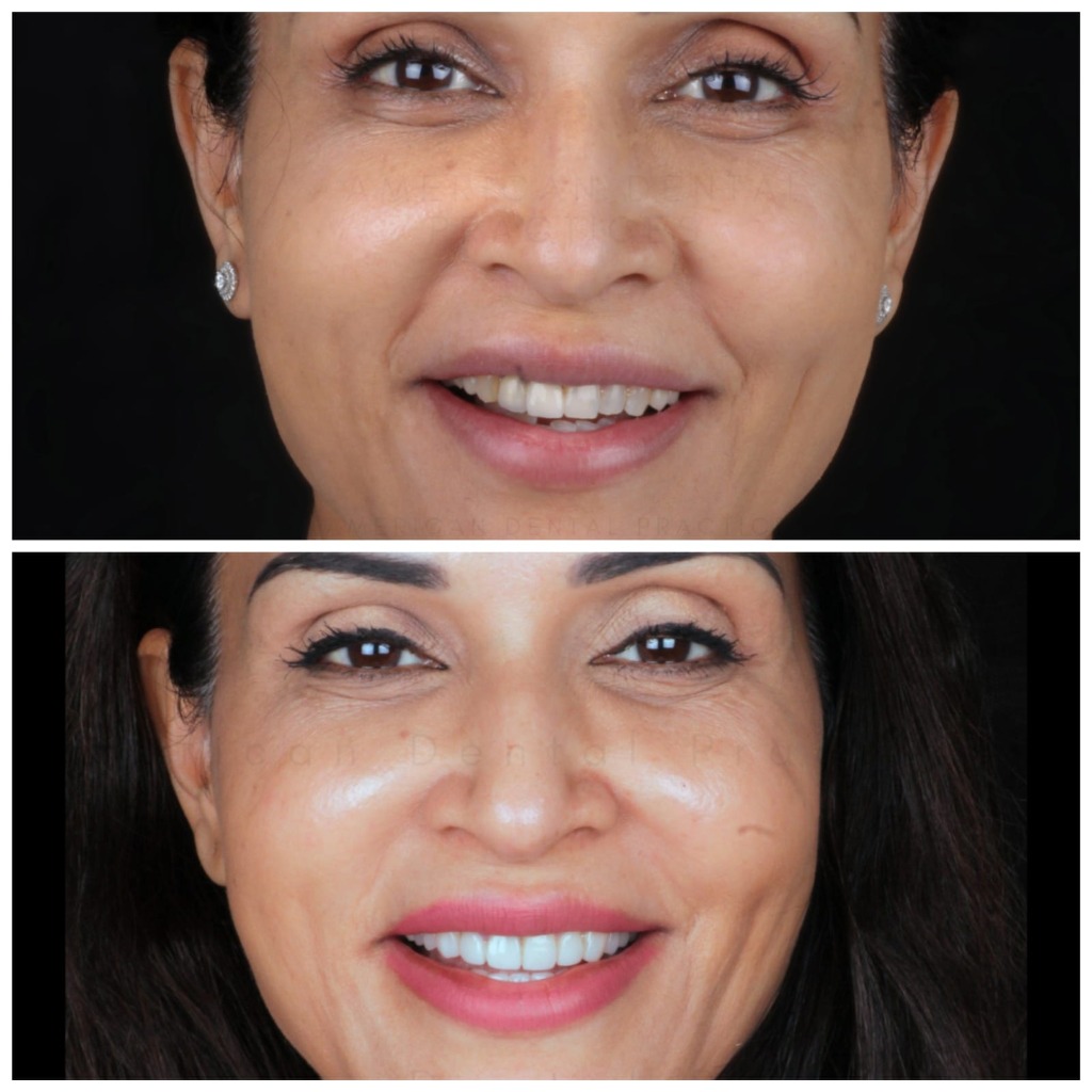 Real Patient Result 1 Before