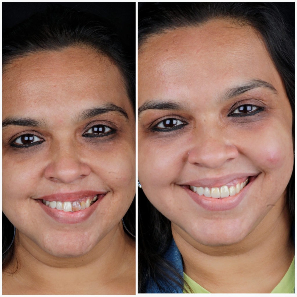 Real Patient Result 6 Before
