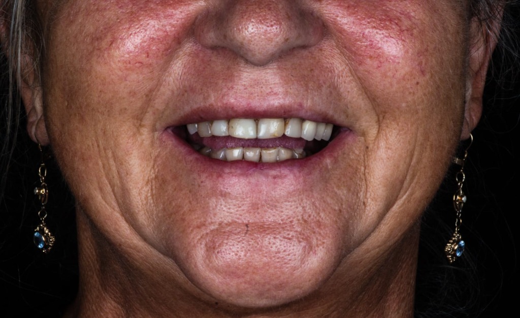 Real Patient Result 2 Before