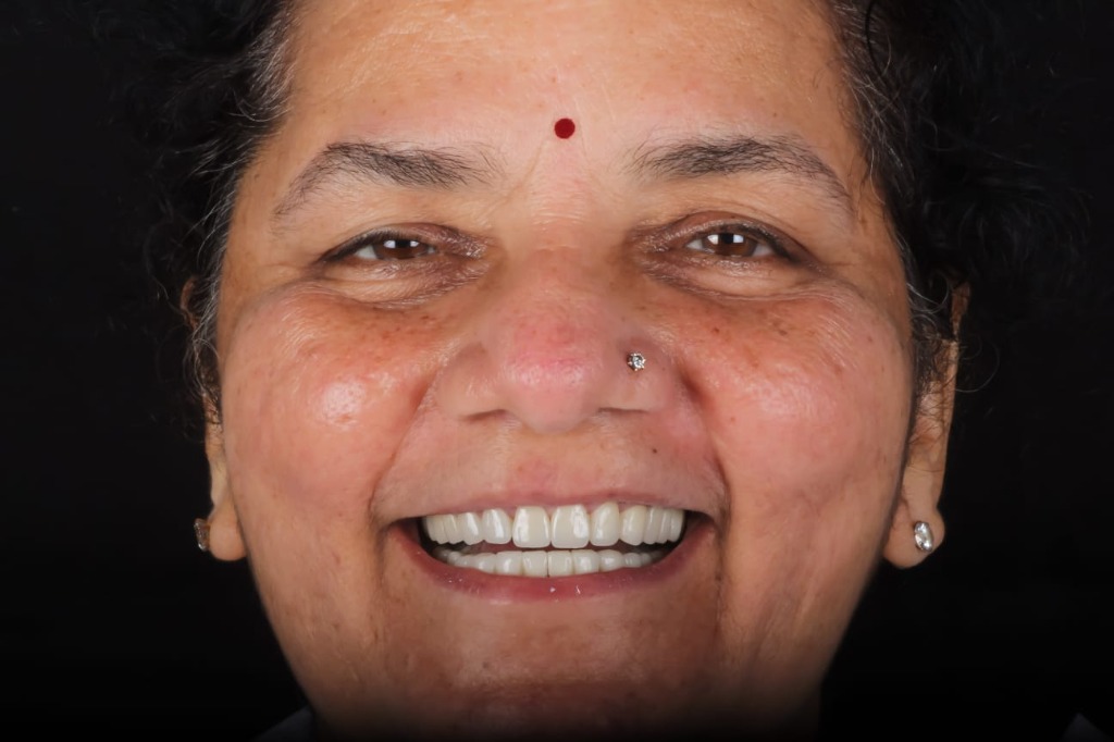Real Patient Result 4 After