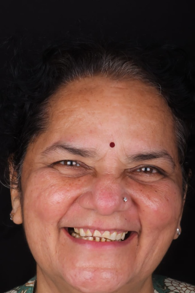 Real Patient Result 4 Before