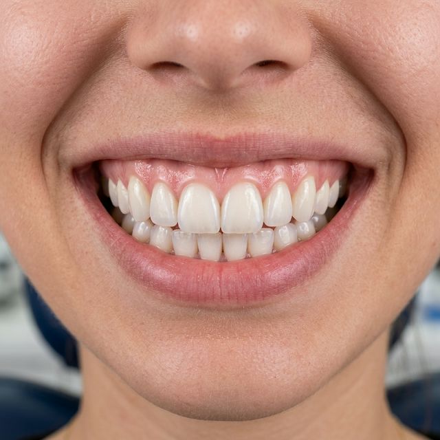 Real Patient Result 5 After